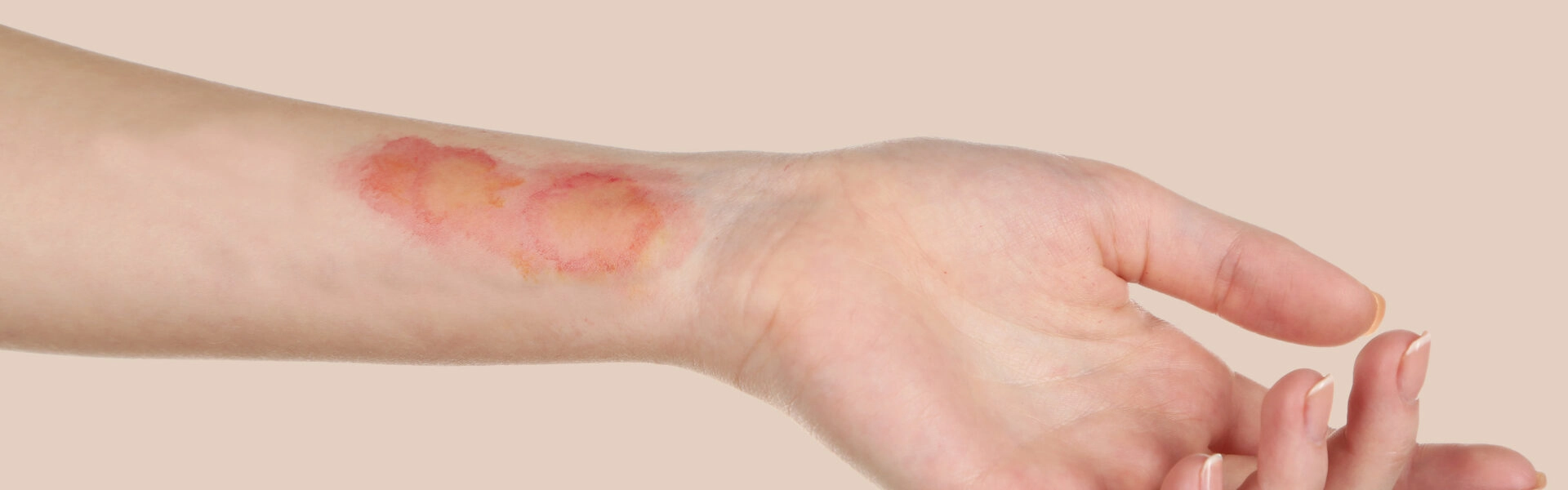 Burns