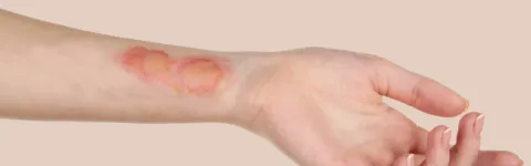 Burns